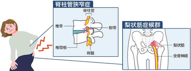 脊柱管狭窄症・梨状筋症候群イメージ