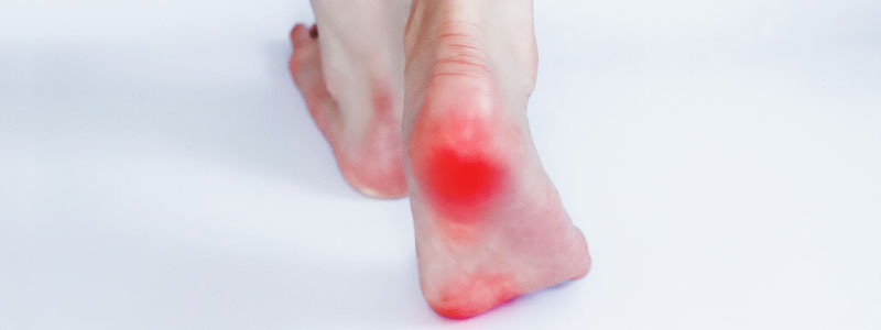 足底筋膜炎イメージ